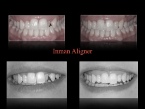 Inman Aligner Loßburg - vorher/nachher Veränderung - Dr. Kasseckert