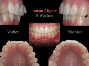 Inman Aligner Loßburg - vorher/nachher Veränderung in 8 Wochen - Dr. Kasseckert