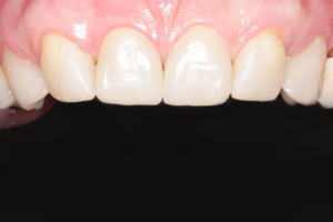 Zahnarzt-Lossburg-Kasseckert-non-prep-veneers-02b